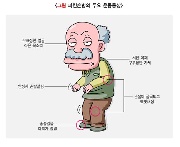'파킨슨병' 증상, 중증도에 따라 5단계 구분…치료법은? : 네이트 뉴스